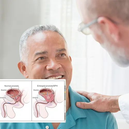 Welcome to  Urological Consultants of Florida 
: Finding the Best Penile Implant for Your Needs